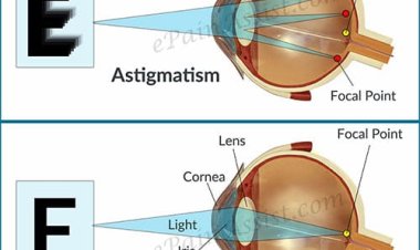 Cara Sembuhkan Mata Silinder