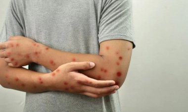 Ancaman Global Mpox: Dinamika Penularan, Hambatan Penanganan, dan Prospek Terapeutik