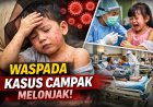 Kasus Campak Kembali Meningkat, Masyarakat Diminta Waspada dan Lengkapi Imunisasi